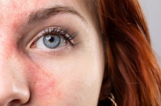 Des traitements contre la rosacee et l-acne cancerigenes si mal conserves ! 