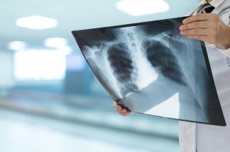 Tuberculose : 2 nouveaux antibiotiques, moins toxiques, arrivent sur le marche 