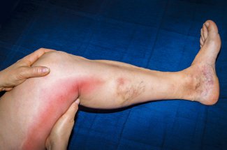 Maladie veineuse thromboembolique : les 15 departements les plus touches