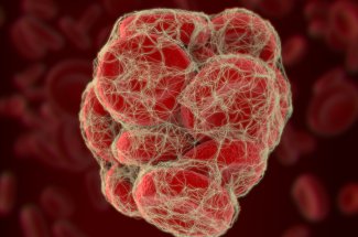 Embolie pulmonaire : quels sont les departements les plus touches ?