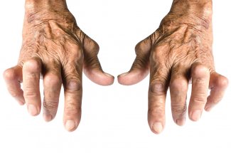 Polyarthrite rhumatoide : les sept gestes a faire pour limiter la douleur