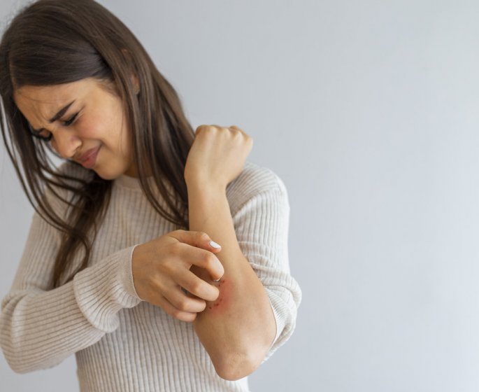 Urticaire : causes, symptomes, traitements, que faire en cas de crise ? 