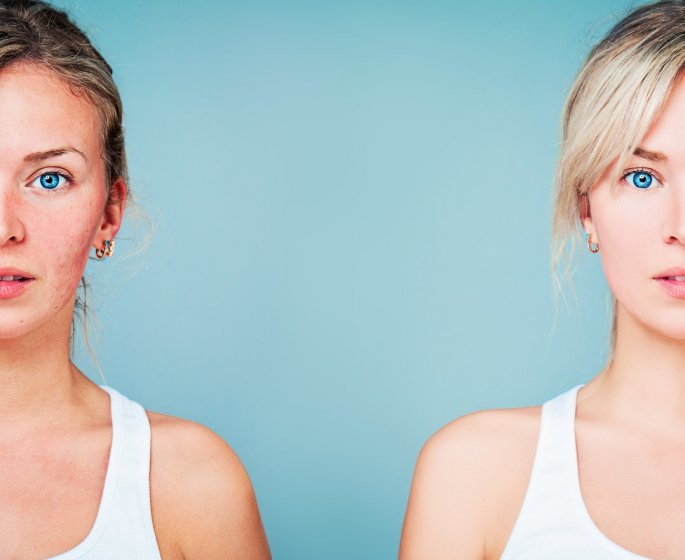 Couperose ou rosacee (nez, visage) : quels causes et traitements (laser, cremes) ?