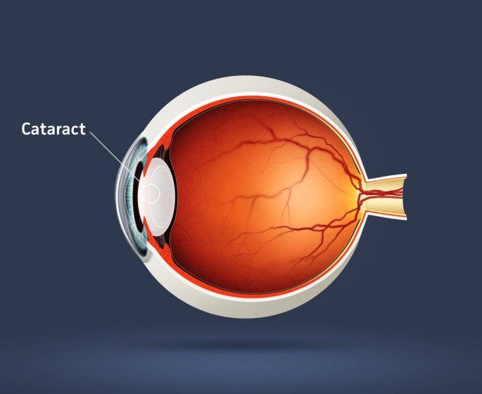 Cataracte : definition, symptomes, operation et traitements 