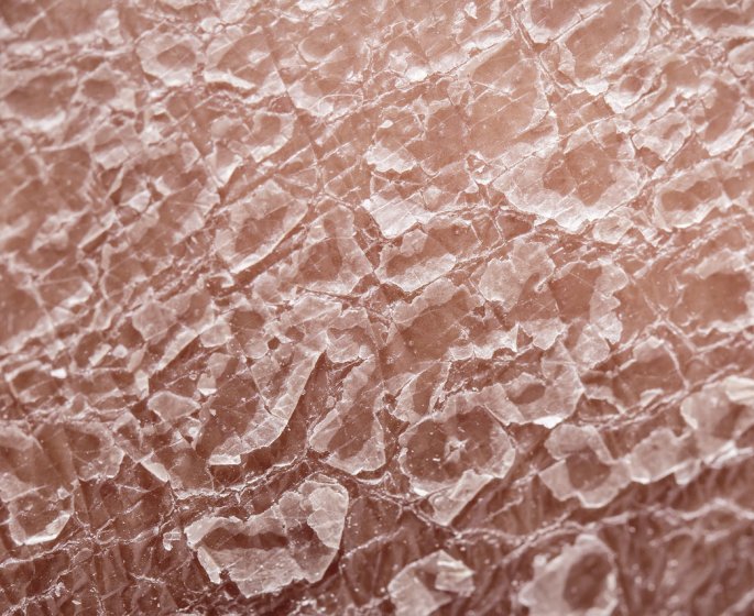 Dermite seborrheique (cuir chevelu, visage…) : quels traitements, causes et symptomes ? 