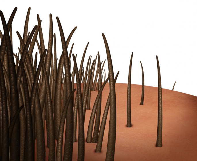 Alopecie (chute de cheveux) : causes, manifestations et traitements