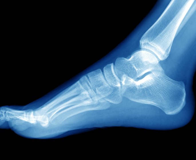 Epine calcaneenne (epine de Lenoir) : douleur au talon, que faire pour la soulager ?