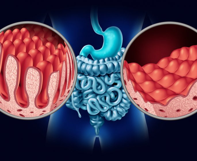  Maladie cœliaque (intolerance au gluten) : symptomes, diagnostic et traitements