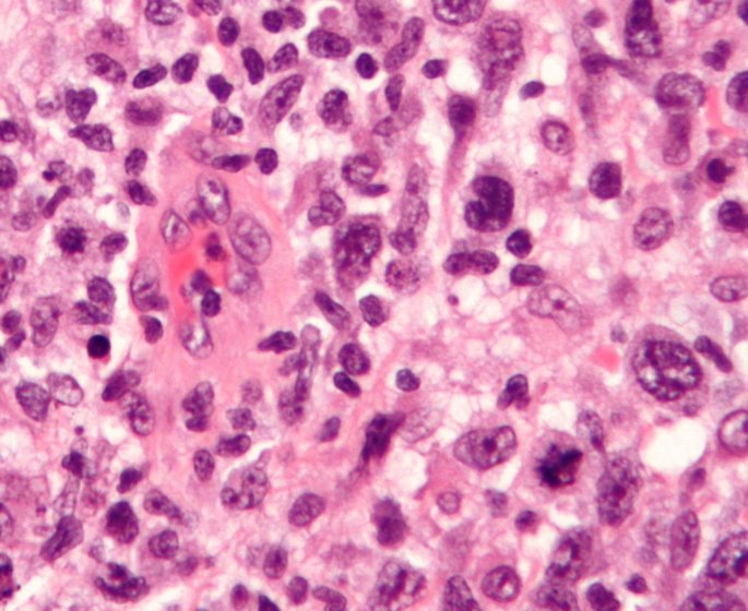 Lymphome : symptomes, traitements du cancer du systeme lymphatique