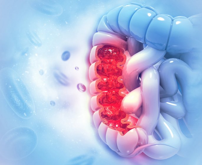 Hemochromatose (genetique) : symptomes, diagnostic, traitements