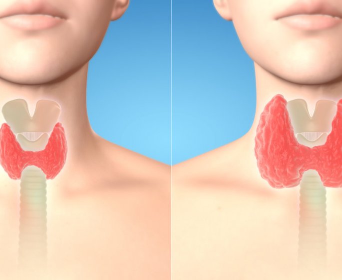 Goitre : definition, causes, symptomes, traitements