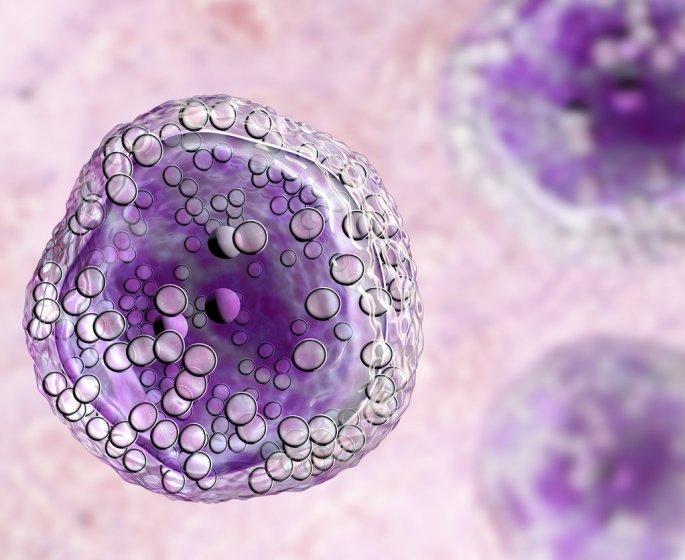 Lymphome de Burkitt : symptomes, diagnostic, traitements, complications
