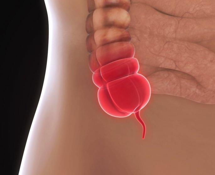 Appendicite : symptomes, signes de crise d-appendicite, operation, causes