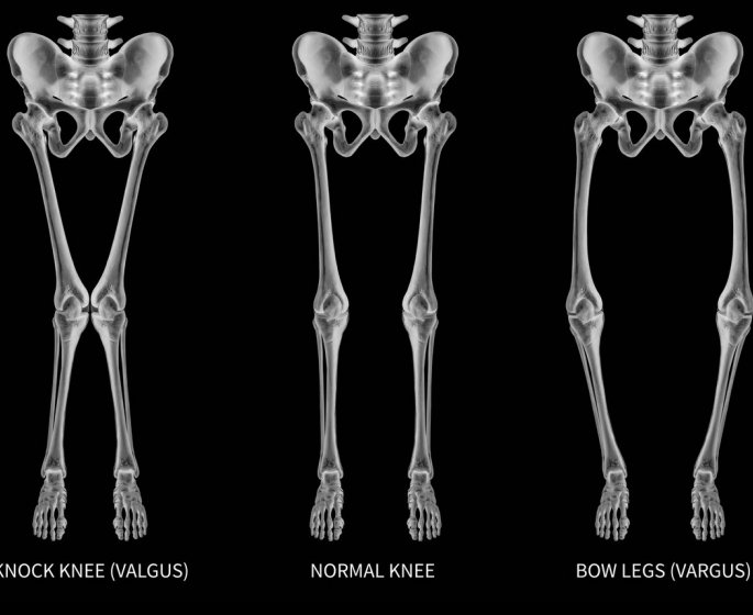Genu varum : definition, causes, traitements des jambes arquees