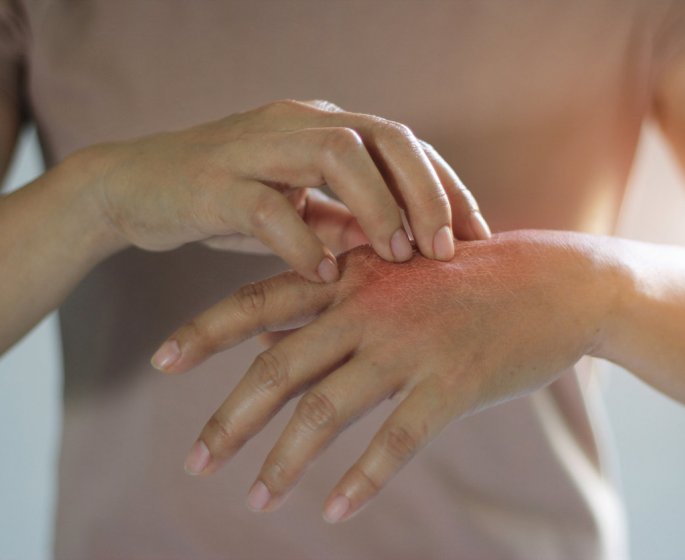 Eczema des mains, doigts : causes, quels traitements pour le soigner ?
