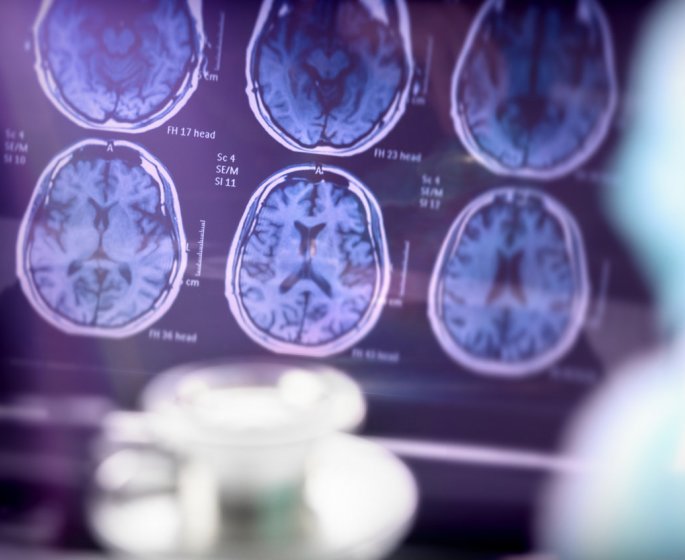 Maladie a corps de Lewy : symptomes, diagnostic, evolution, traitements
