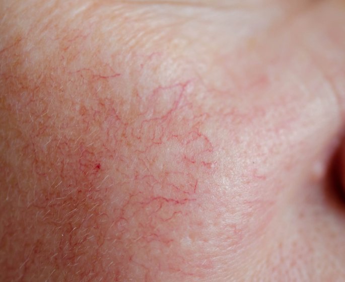 Telangiectasie : definition, causes, traitements