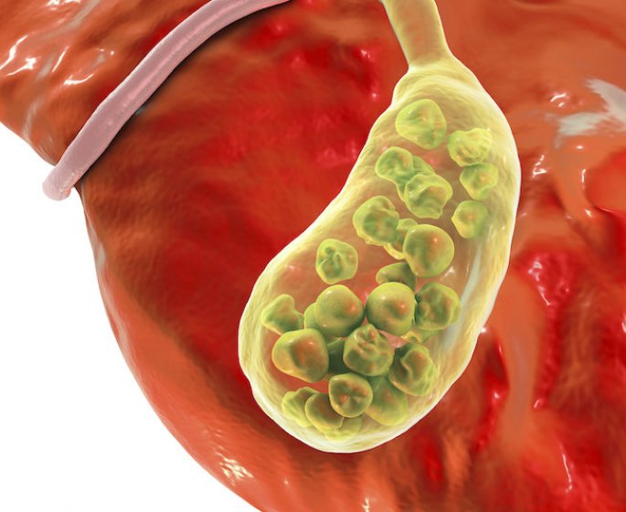  Calculs biliaires (Lithiase vesiculaire) : symptomes, causes, traitements