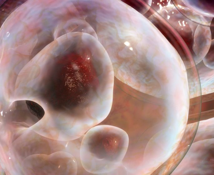 Kyste pilonidal (sacro coccygien) : symptomes, traitements, operation au laser ?