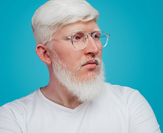 Albinisme : etre albinos, causes, symptomes, transmission