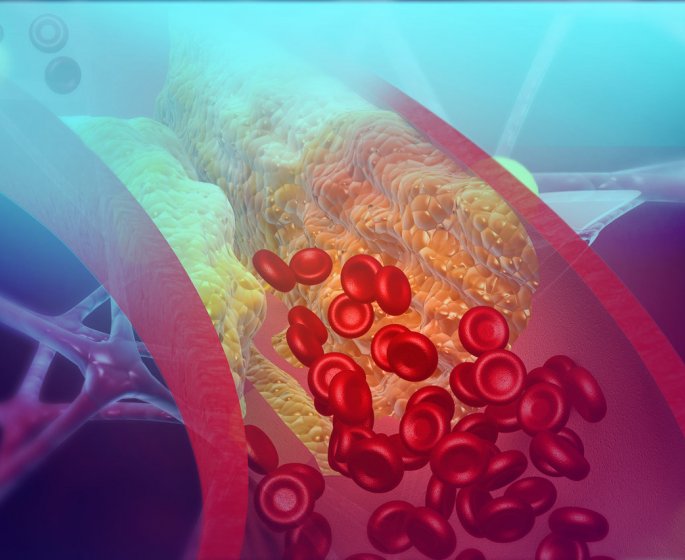 Atherosclerose : symptomes, traitements, consequences, prevention