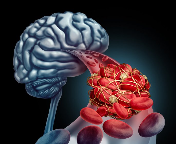 Anevrisme aorte abdominale, cerebral... : symptomes, causes, traitements