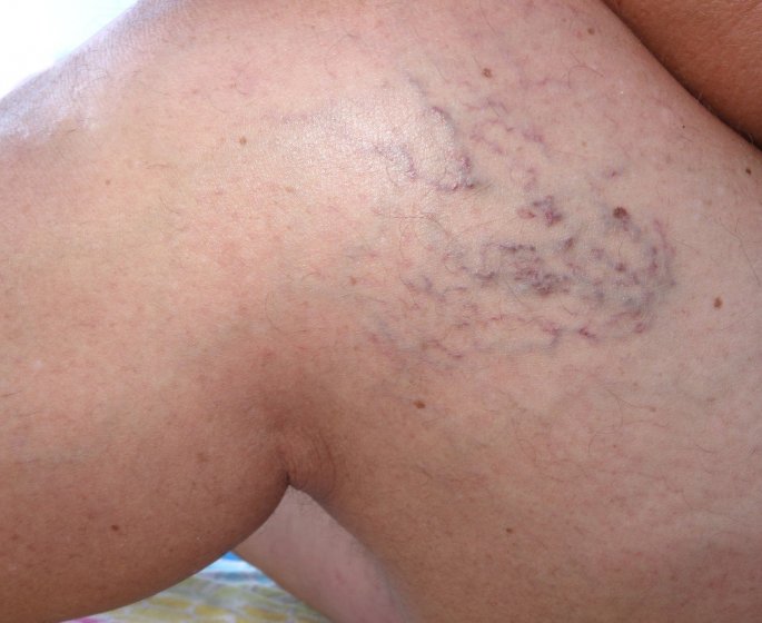 Insuffisance veineuse : symptomes, traitements, causes, risques