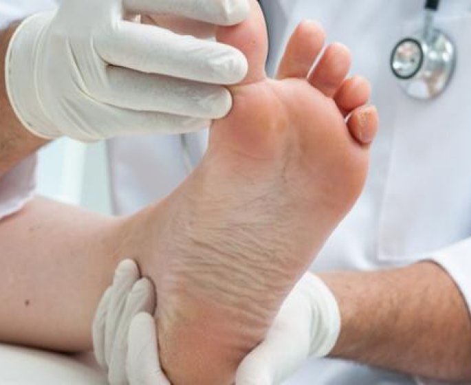 Pied d-athlete ou Mycose des pieds entre les orteils : quels traitements ?