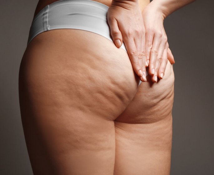Cellulite : reduire l’effet peau d-orange avant l’ete 