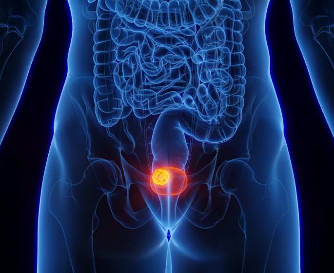 Cancer de la vessie : un traitement efficace decouvert pour les patients a un stade avance