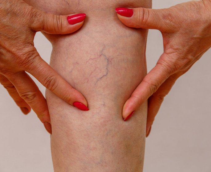 Phlebite et varice : quelles differences ?