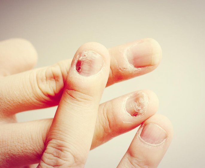 Panaris ou mycose de l-ongle : quelle difference ?