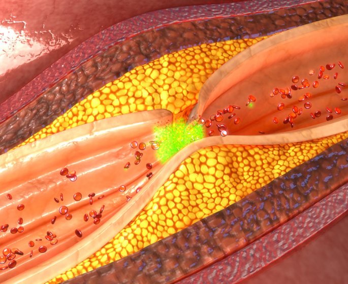 Atherosclerose : le diagnostic par angiographie
