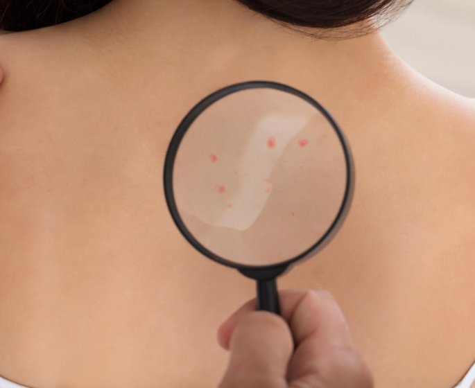 Demangeaison cutanee : reconnaitre des boutons d-allergie