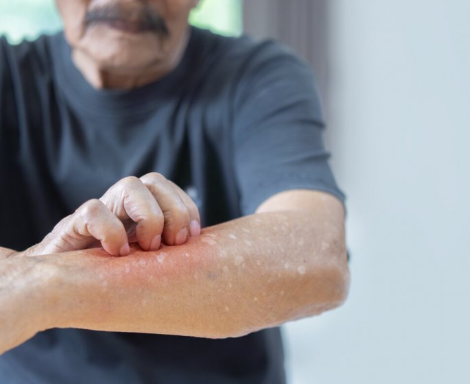 Un vaccin contre l’eczema arrive en France !