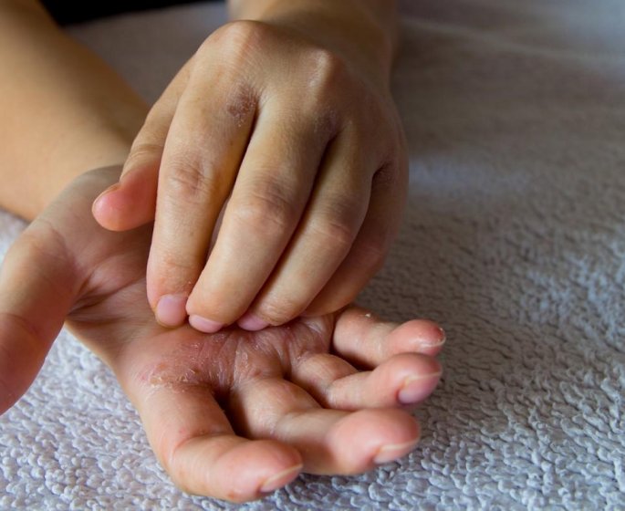 Le psoriasis lie a un risque de maladies cardiovasculaires ?