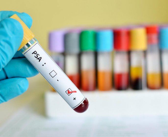 Prostate : le dosage sanguin du PSA