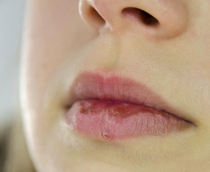 Bouton de fievre et grossesse : un remede