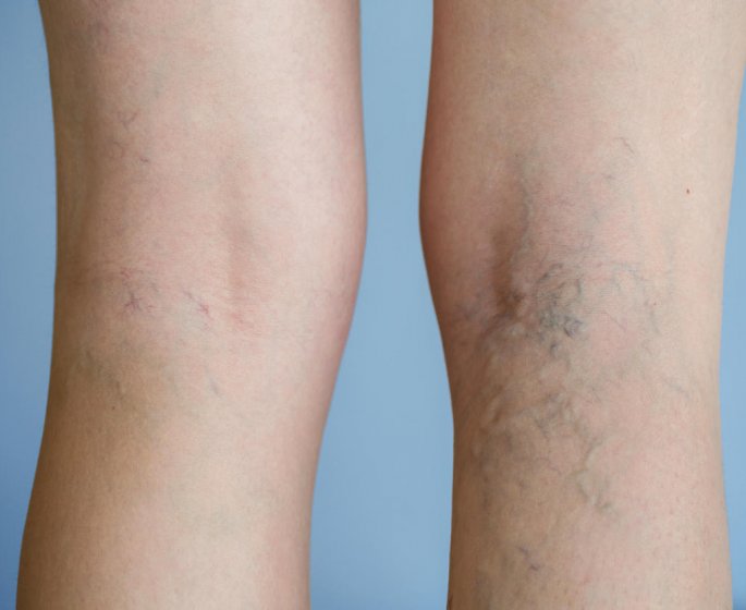 Operation des varices : les complications