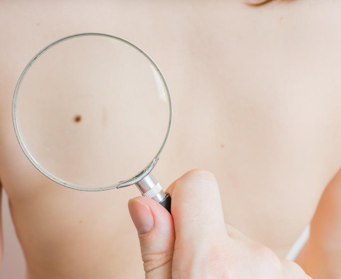 Carcinome : qu-est-ce que la maladie de Bowen