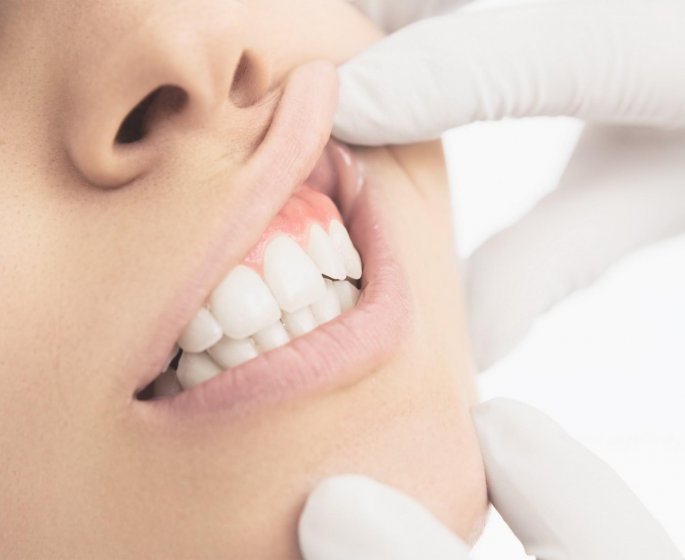 Leucoplasie de la langue, de la bouche et des gencives : symptomes et traitements