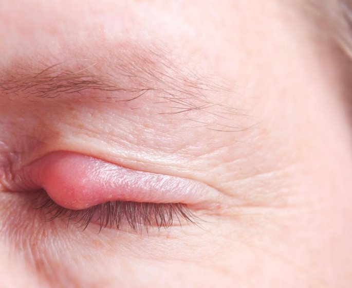 Chalazion ou orgelet : la difference