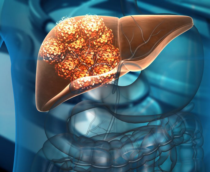 Cancer du foie : quelles sont les personnes a risque ? 