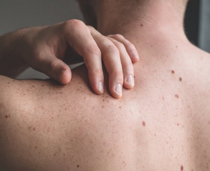 Cancer de la peau : les differentes formes a (re)connaitre