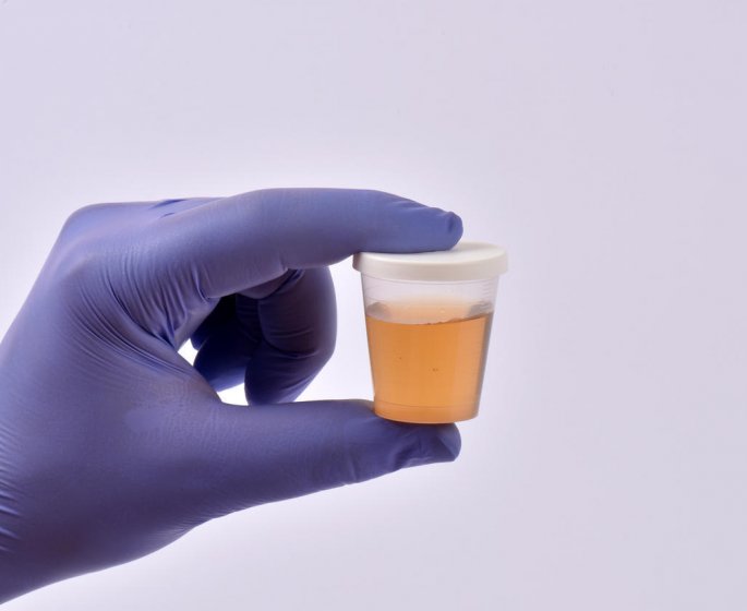 Sang dans les urines : l-examen de cytologie urinaire
