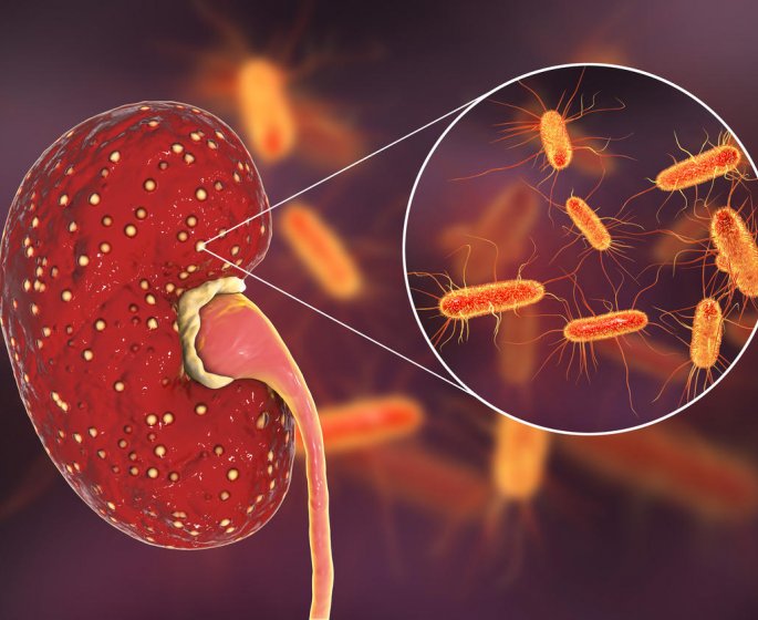 Pyelonephrite : les symptomes de cette infection renale