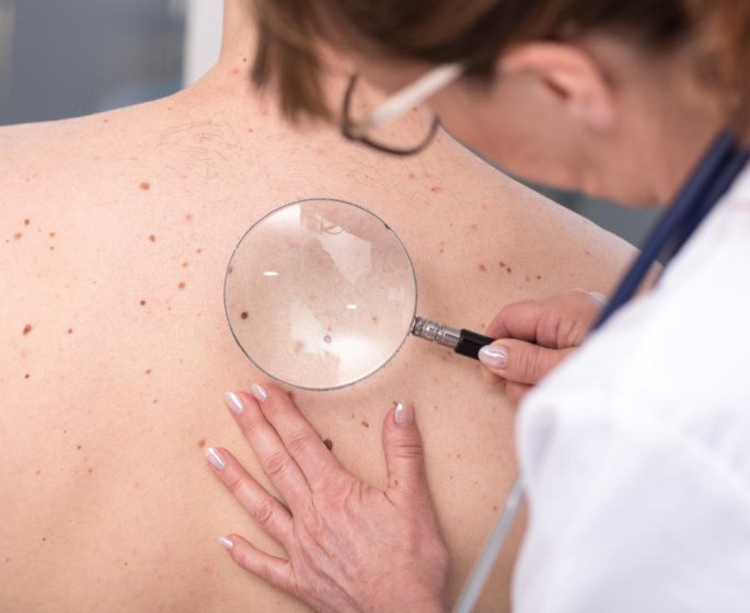 Melanome : le cancer qui touche de plus en plus d’hommes