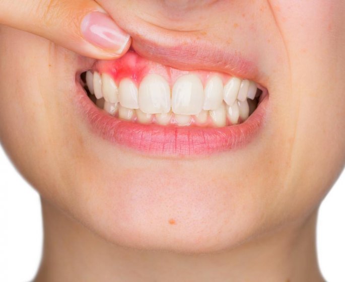 Gencives qui saignent : 6 conseils pour en finir