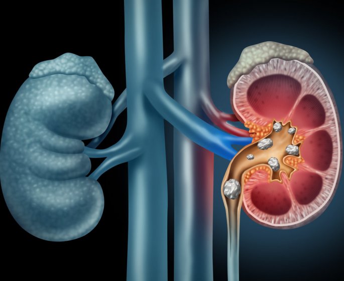 Calculs renaux (lithiase renale) : symptomes, traitements, temps pour evacuer un calcul renal