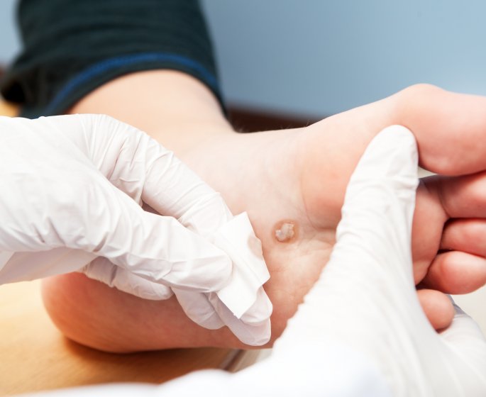 Verrue seborrheique : l-homeopathie est-elle efficace ?